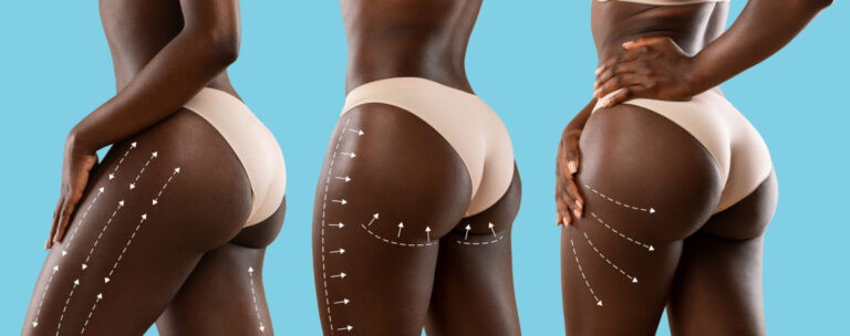 BBL vs Butt Implants: Which is Right for You?